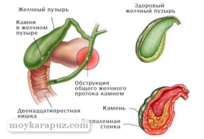 Холецистит