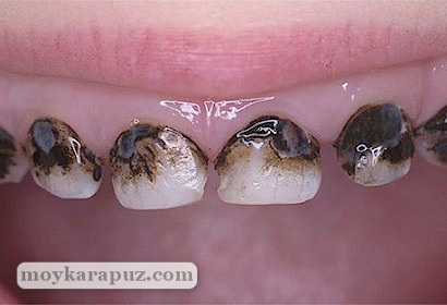 Черные молочные зубы