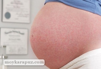 Сыпь на теле у беременной