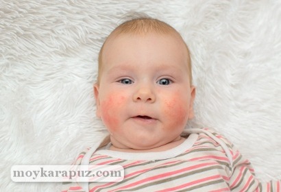 Почему возникают красные щеки у ребенка
