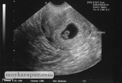 Эмбрион на снимке