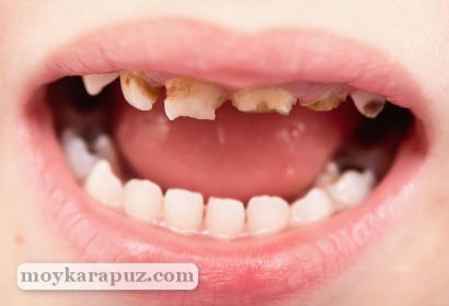 Больные молочные зубы
