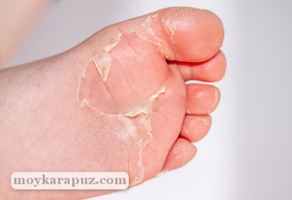 Шелушение кожи на ногах
